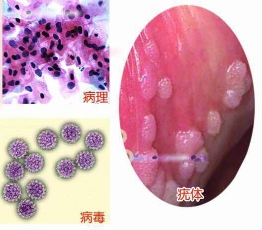 疣体一个月能长大多少，生长速度与影响因素解析