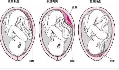 胎盘低置，应对与护理的六个月旅程